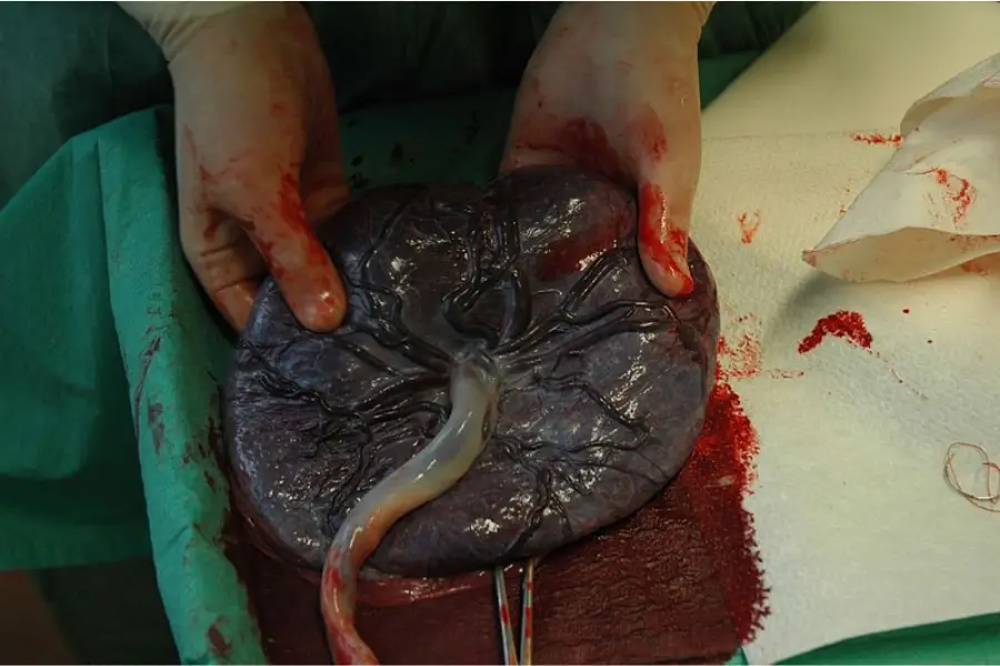 Delivery of the placenta