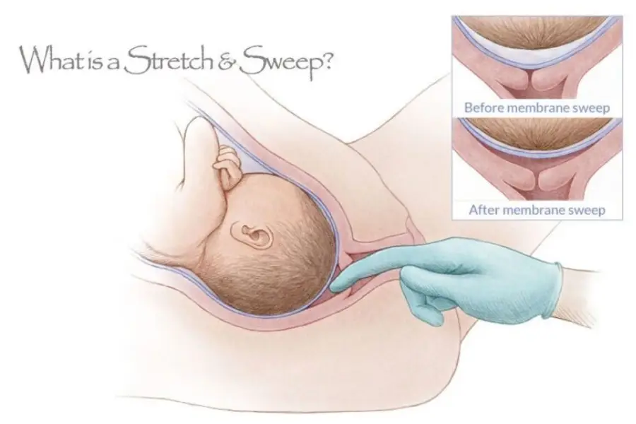 What is a Membrane Sweep