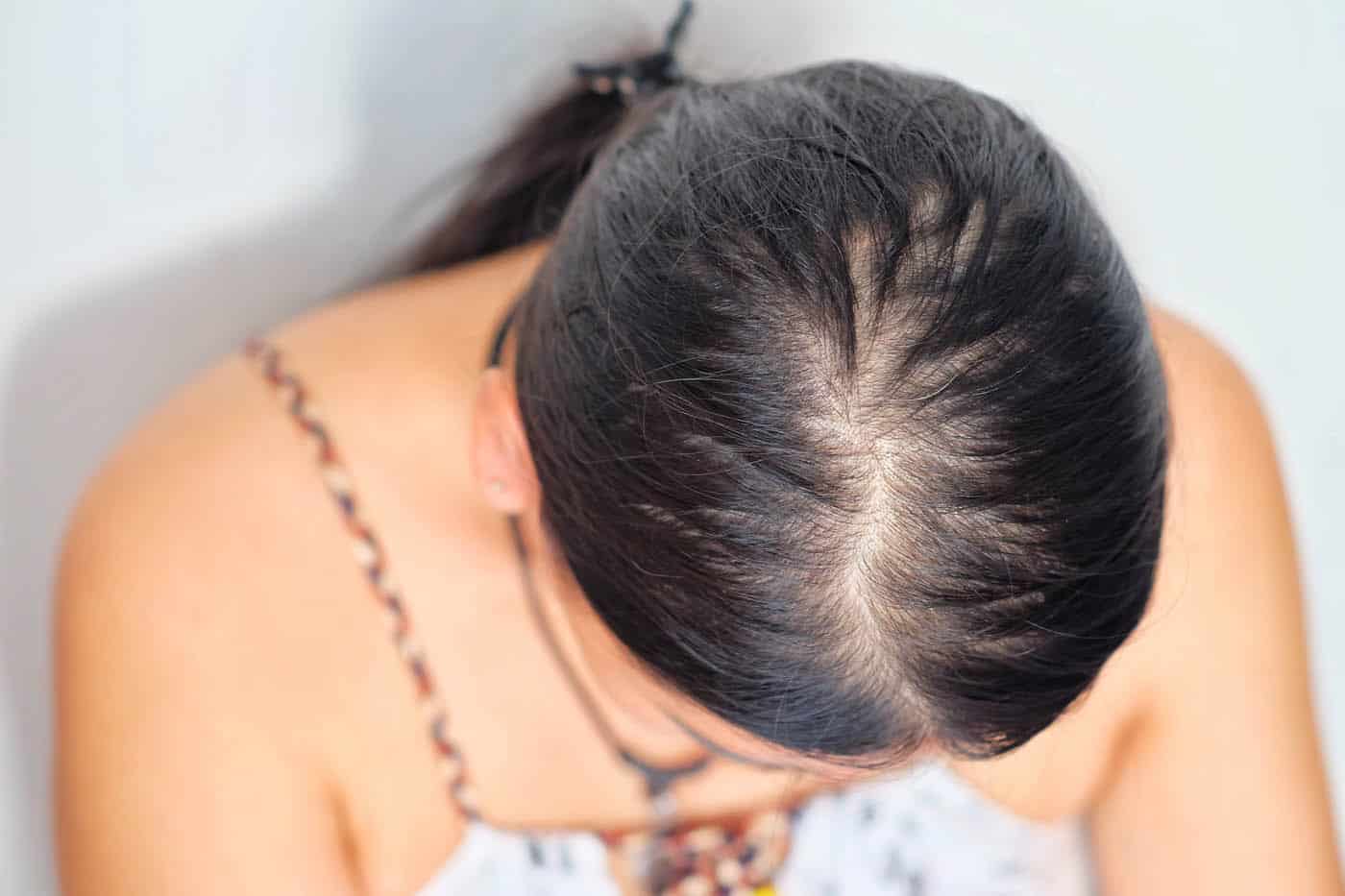 postpartum hair loss treatment options